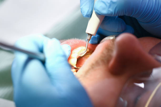 Best Emergency Wisdom Teeth Removal in Conyers, GA